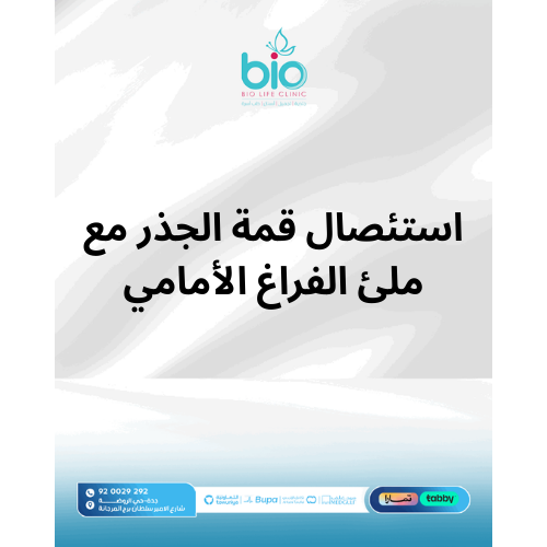 استئصال قمة الجذر مع ملئ الفراغ الأمامي